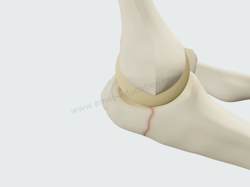 Fracture d'olécrâne non déplacée (Mayo I) : le trait visible par un liseré rouge.