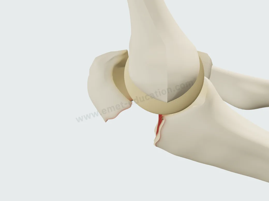 Fracture d'olécrâne très déplacée, écart de 20 mm : le fragment proximal ascensionné.