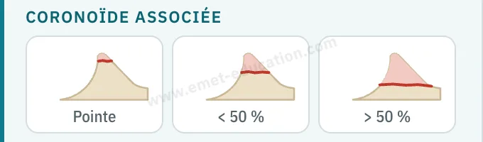 Panneau du modèle : fracture associée de la coronoïde, pointe, moins de 50 %, plus de 50 %.