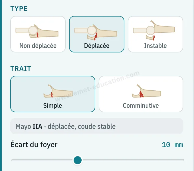 Panneau du modèle : type de fracture (non déplacée, déplacée, instable), trait (simple, comminutif), classification Mayo IIA, écart du foyer de 10 mm.