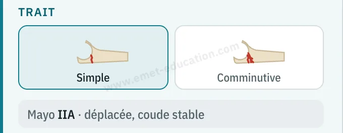 Panneau du modèle : trait simple ou comminutif, classification Mayo IIA.