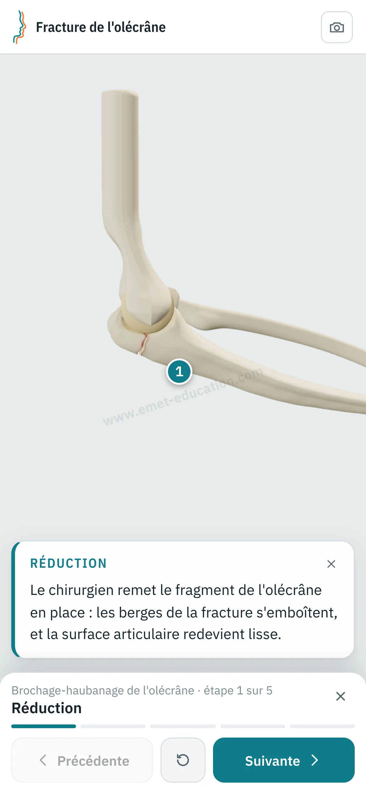Vue patient sur un téléphone : le brochage-haubanage rejoué étape par étape.