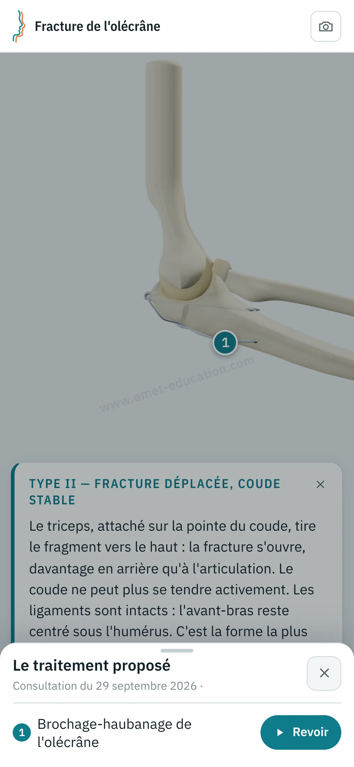 Vue patient sur un téléphone : le coude après haubanage, la carte « Type II, fracture déplacée, coude stable », et le volet « Le traitement proposé » ouvert : brochage-haubanage de l'olécrâne, bouton « Revoir ».