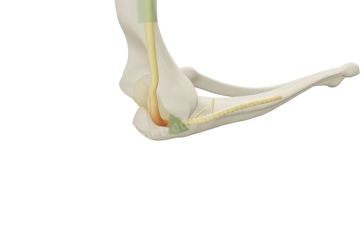 Modèle 3D du coude vu de l'intérieur : le nerf ulnaire comprimé sous une bande fibreuse, en arrière de l'épicondyle médial, gonflé juste au-dessus.