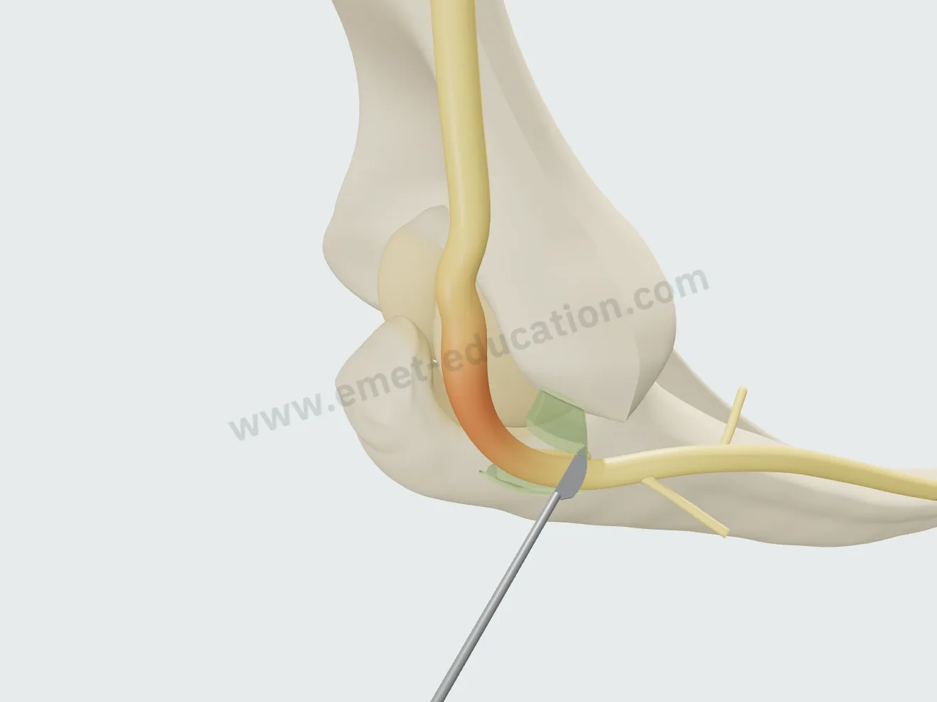 Neurolyse, deuxième étape : le ligament d'Osborne est ouvert le long du nerf, ses deux bords écartés.