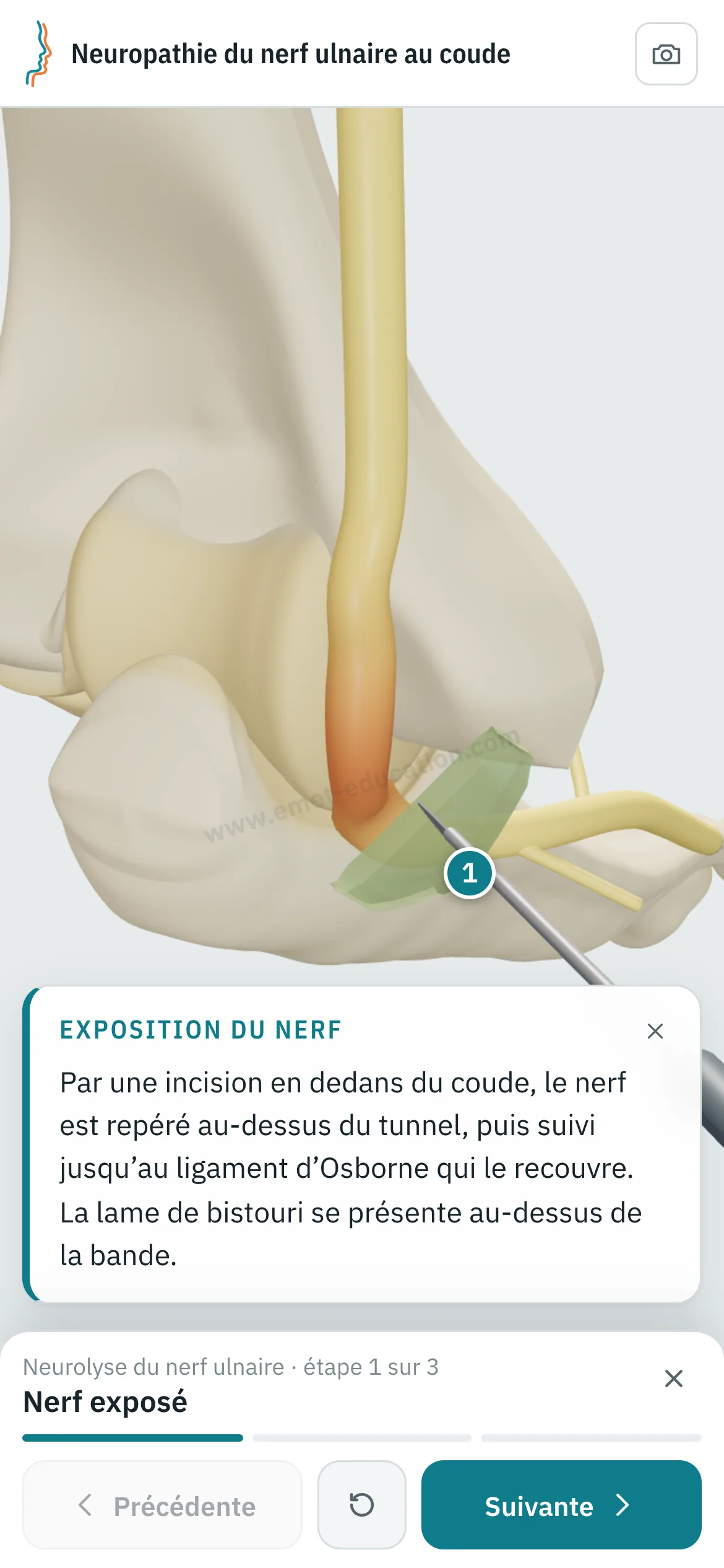 Vue patient sur un téléphone : la neurolyse du nerf ulnaire rejouée étape par étape.