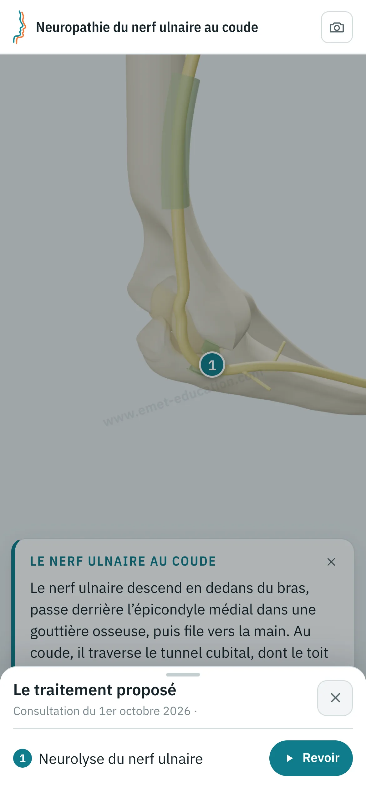 Vue patient sur un téléphone : le coude après neurolyse du nerf ulnaire, et le volet « Le traitement proposé » ouvert, avec le bouton « Revoir ».