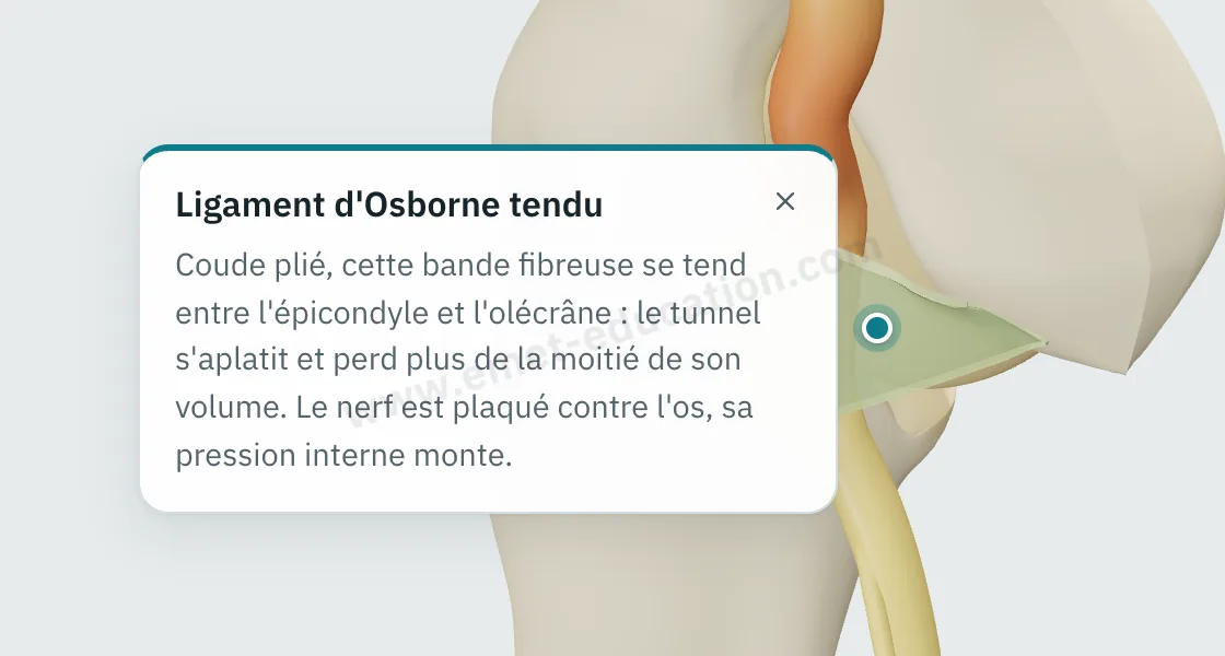 Bulle d'explication « Ligament d'Osborne tendu » affichée après un toucher sur le ligament, au-dessus du nerf comprimé.