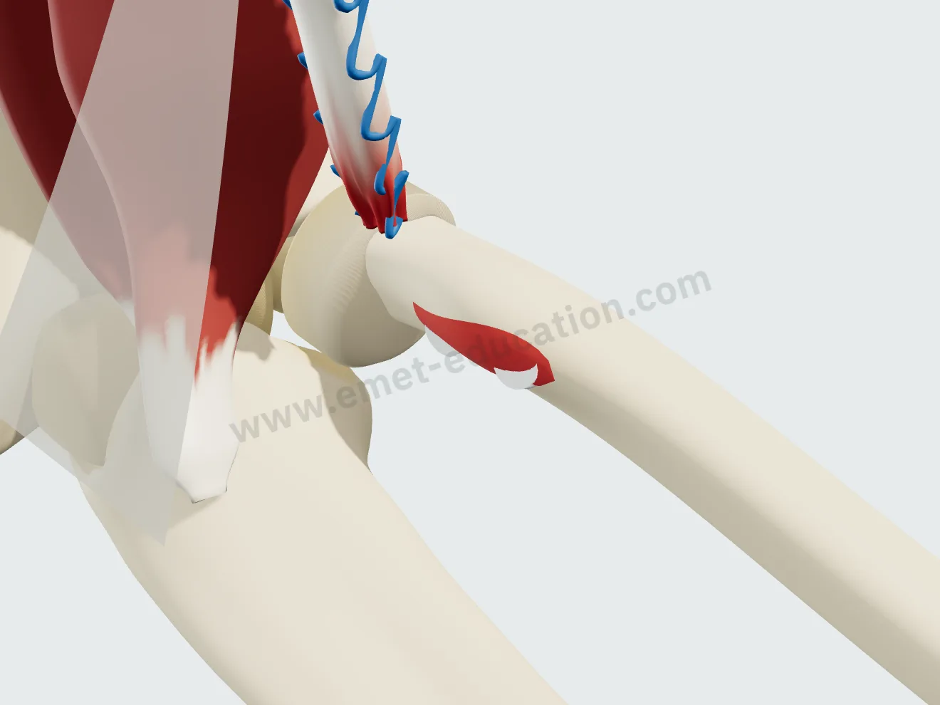 Le tendon réinséré a lâché et est de nouveau remonté ; le matériel de fixation reste en place dans l'os.