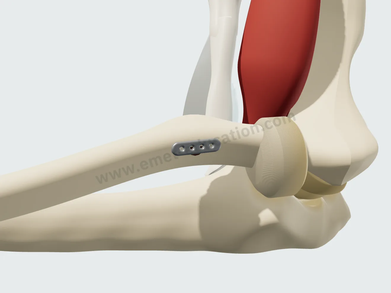 Endobouton : la plaquette s'est retournée et appuie contre la face opposée du radius ; ses fils tiennent le tendon dans la tubérosité.