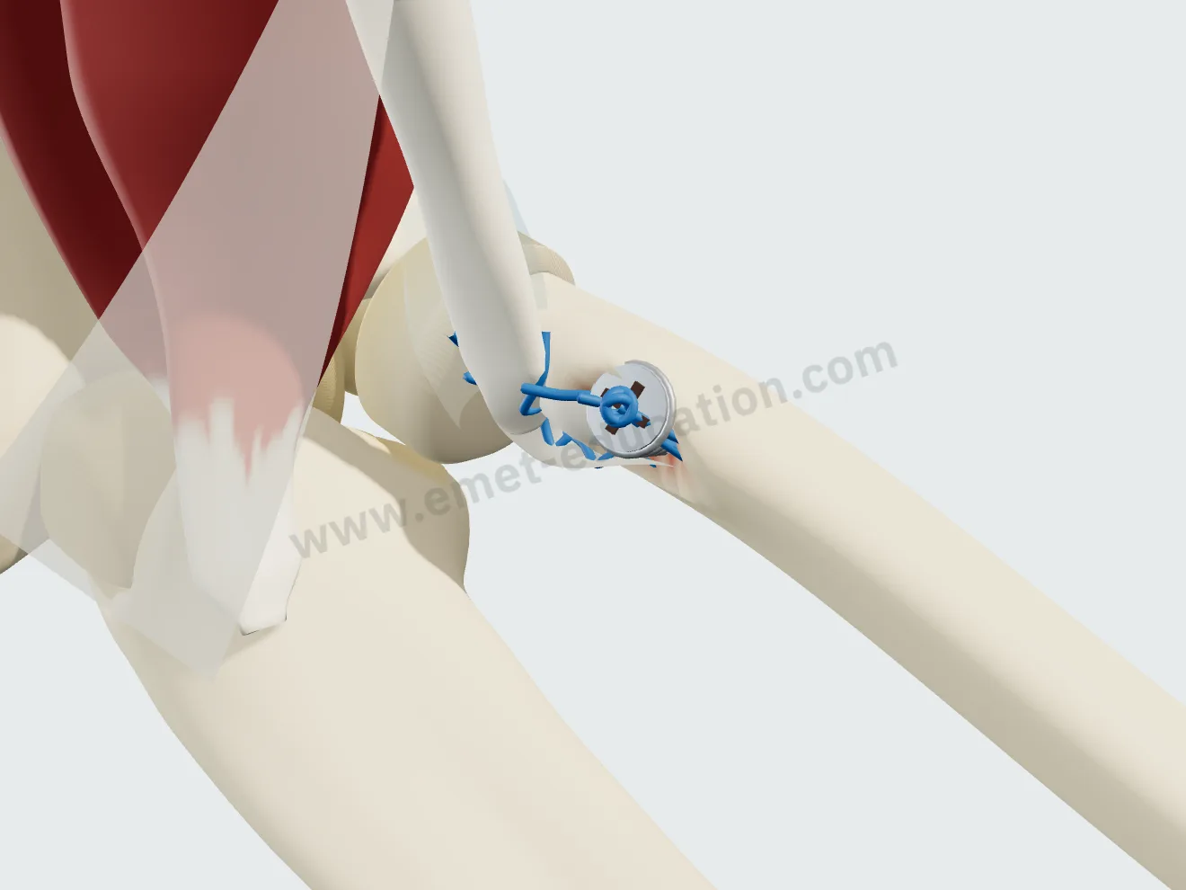 Vis d'interférence : le tendon est enfoncé dans une cavité de la tubérosité, coincé par une vis vissée à côté de lui.