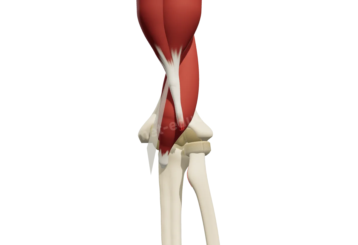 Modèle 3D du coude vu de face : le tendon distal du biceps arraché de son attache sur le radius et remonté dans le bras.