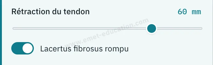 Panneau du modèle : rétraction de 60 mm, « Lacertus fibrosus rompu » activé.
