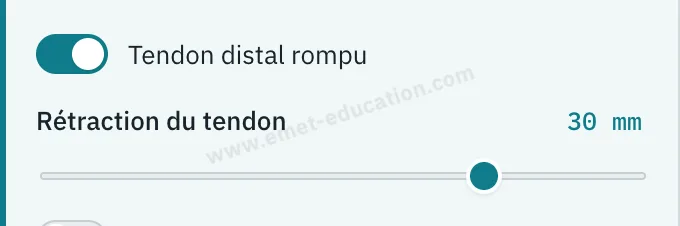 Panneau du modèle : « Tendon distal rompu » activé, rétraction de 30 mm.