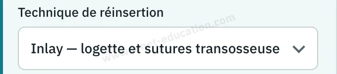 Panneau du modèle : liste « Technique de réinsertion ».