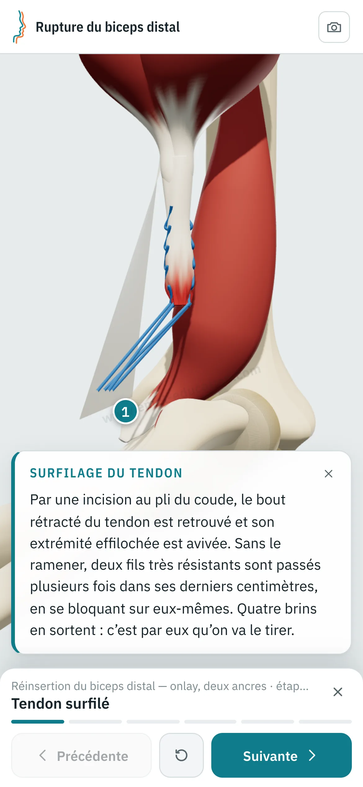 Vue patient sur un téléphone : la réinsertion rejouée étape par étape.