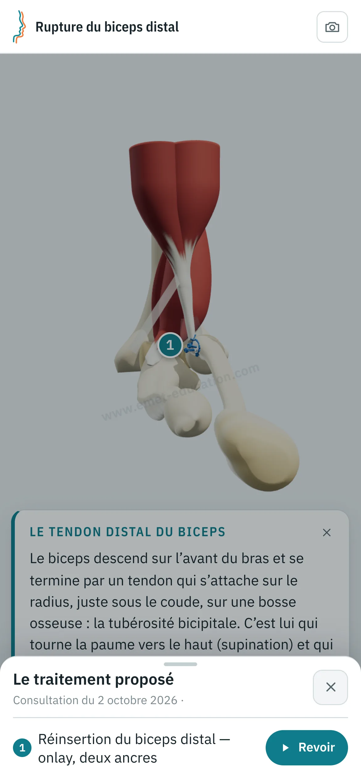 Vue patient sur un téléphone : le tendon réinséré par ancres, et le volet « Le traitement proposé » ouvert, avec le bouton « Revoir ».