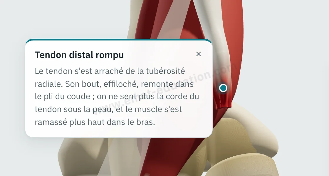 Bulle d'explication affichée après un toucher sur le bout du tendon rompu, au-dessus du pli du coude.