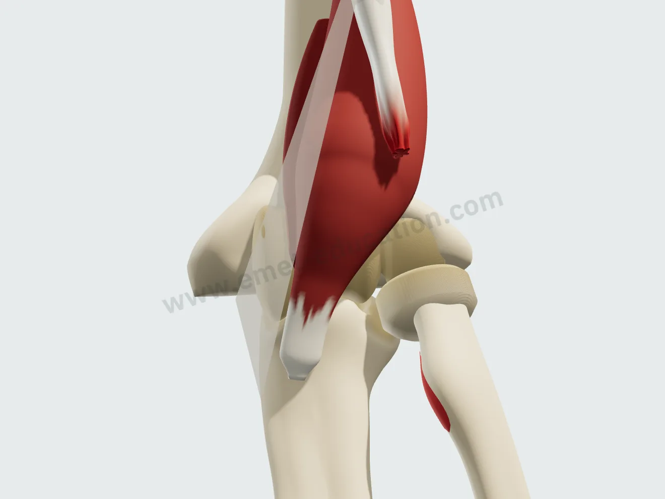 Le tendon remonté de quatre centimètres ; sur le radius, la zone où il s'attachait est à nu.