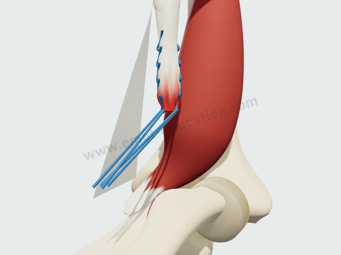 Réinsertion, première étape : des fils sont passés dans l'extrémité du tendon, encore remonté dans le bras.