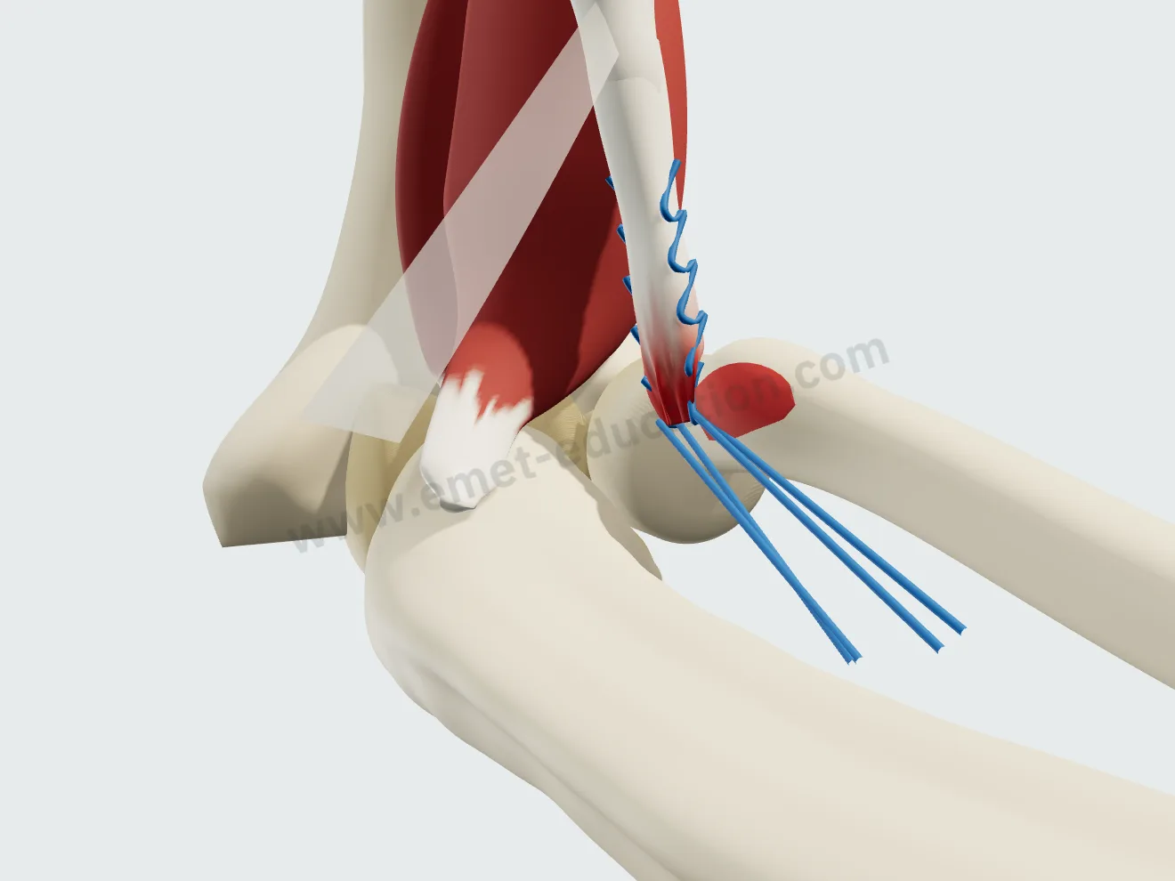 Réinsertion, étape 2 : le tendon ramené sans tension vers la tubérosité.