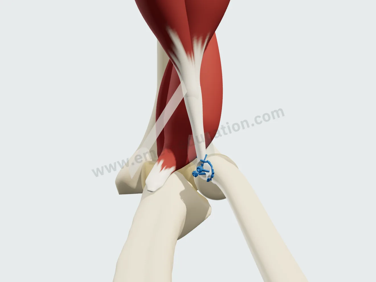 Réinsertion terminée : le tendon est de nouveau fixé sur le radius et suit l'os lorsque le coude s'étend.