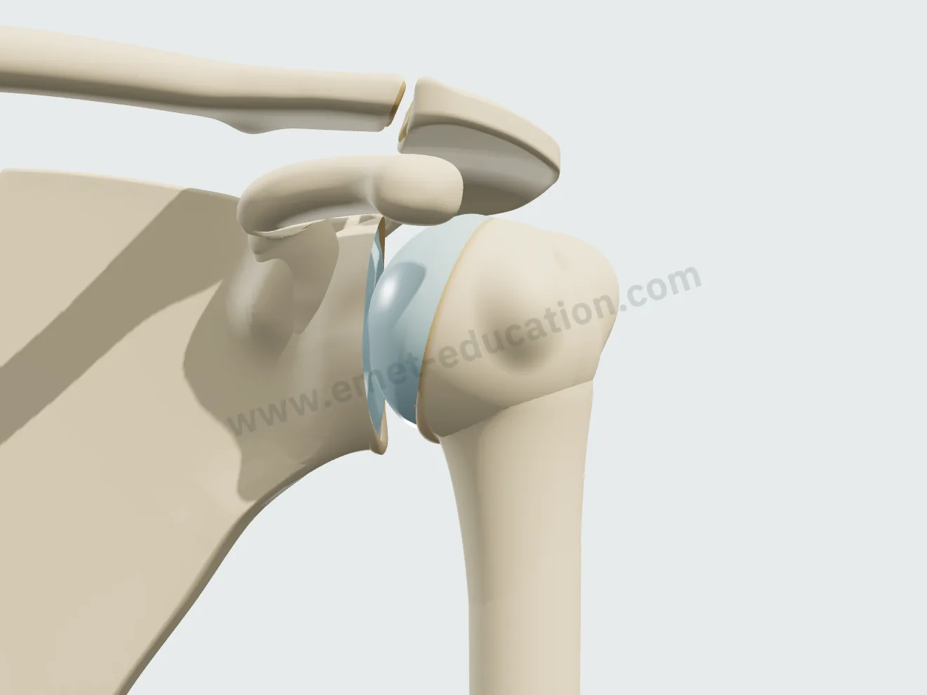 Arthrose débutante : le cartilage commence à s'user, un petit ostéophyte apparaît sous la tête de l'humérus.