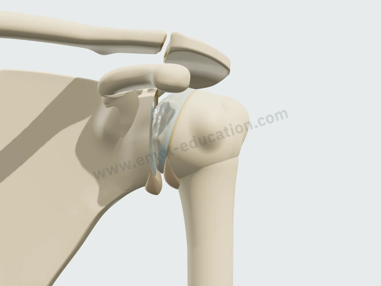 Arthrose centrée grade II : ostéophytes huméral et glénoïdien plus grands, cartilage aminci, tête déformée.