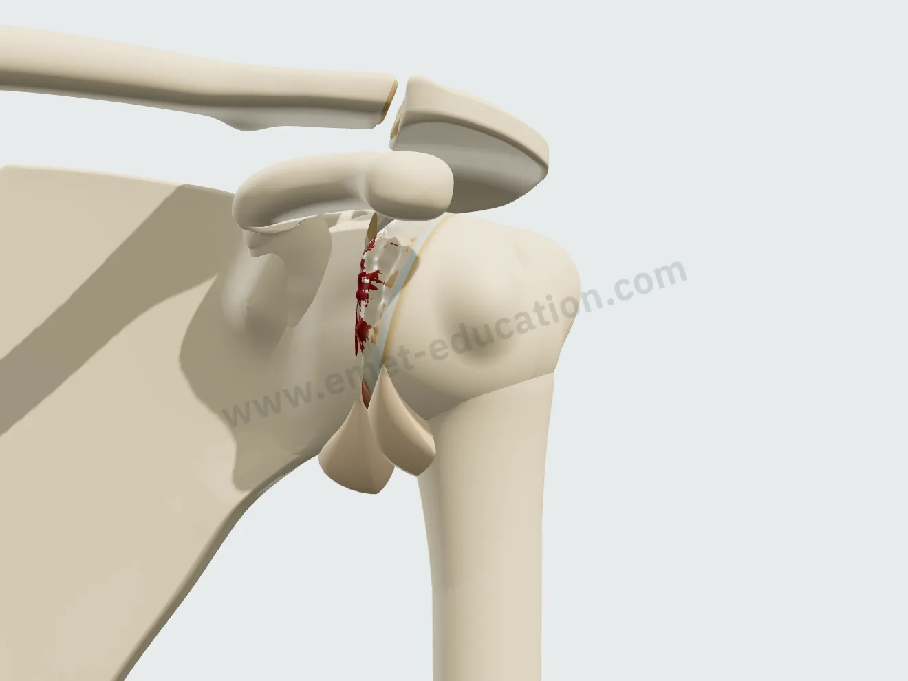 Arthrose sévère : le cartilage a presque disparu, la tête de l'humérus est déformée, les ostéophytes sont volumineux.