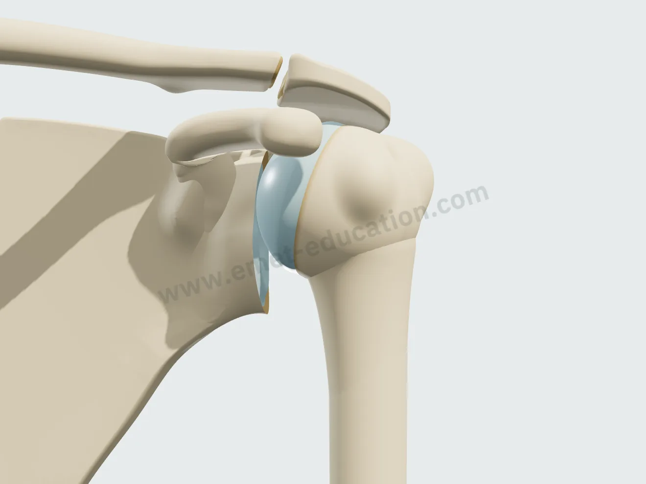 Arthrose excentrée grade 2 de Hamada : la tête humérale monte sous l'acromion, espace sous-acromial réduit à 5 mm ou moins.