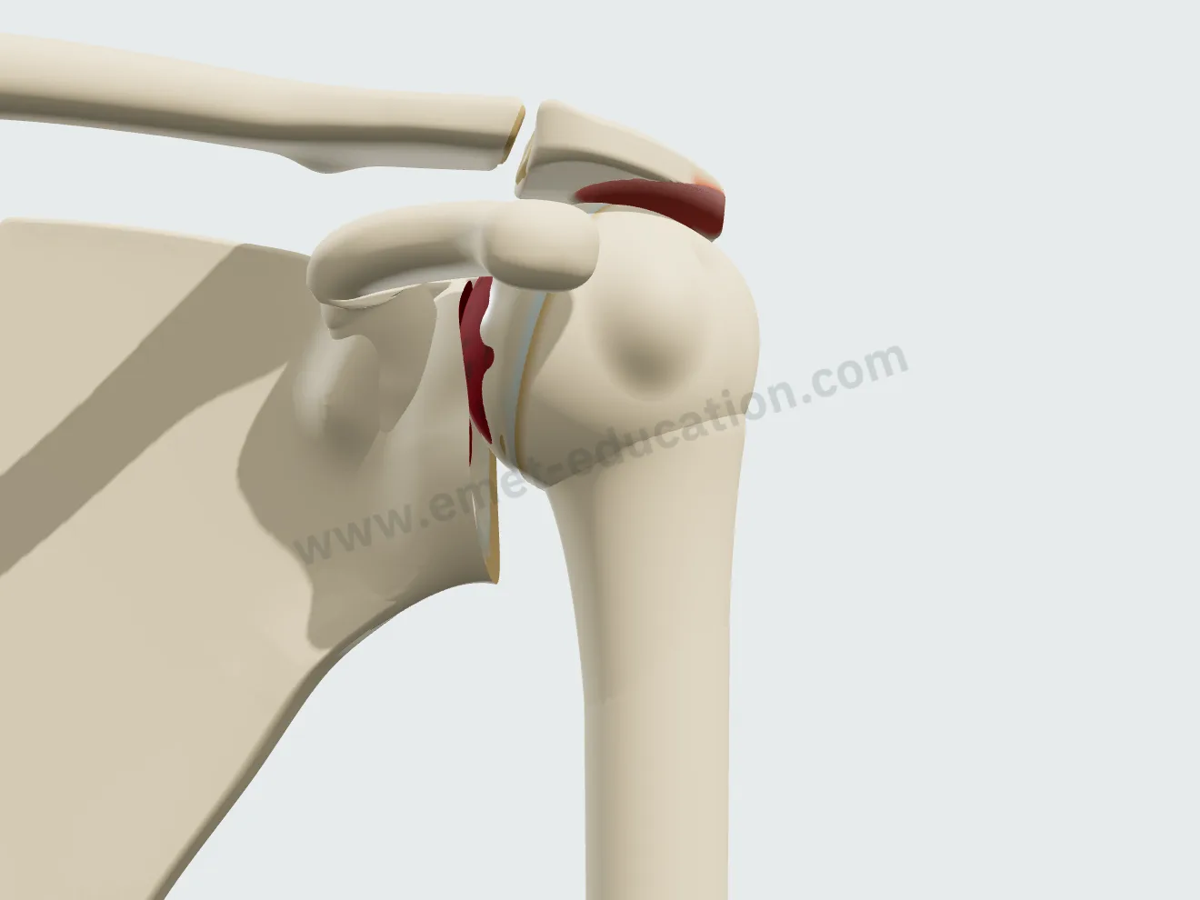 Arthrose excentrée : la tête de l'humérus est remontée sous l'acromion, qui se creuse au-dessus d'elle.