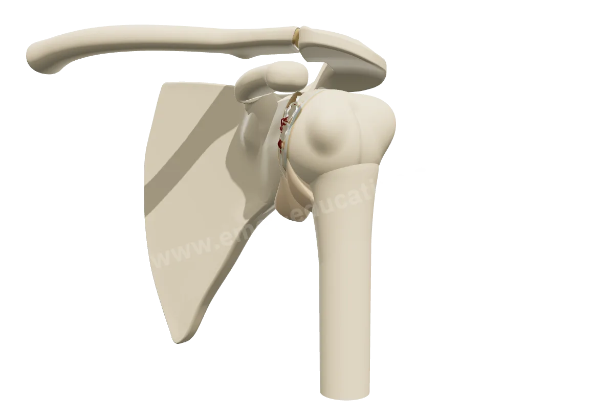 Modèle 3D d'une épaule arthrosique : tête de l'humérus déformée, cartilage usé et becs osseux