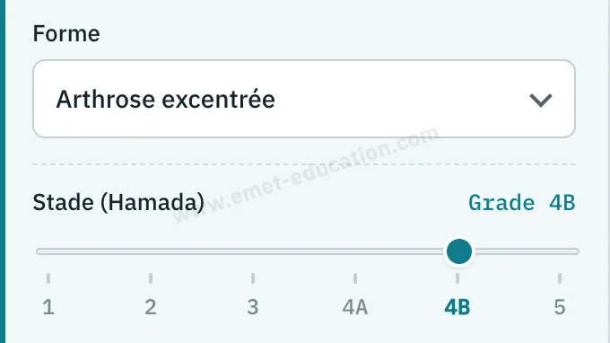 Panneau du modèle : forme « Arthrose excentrée », jauge de Hamada au grade 4B.