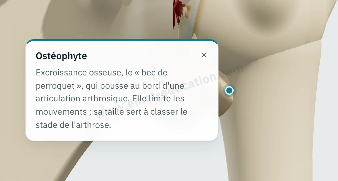 Bulle d'explication affichée après un toucher sur l'ostéophyte huméral, sous la tête.