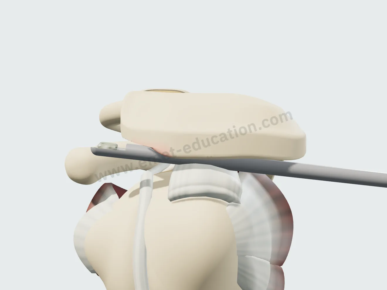 Acromioplastie : une fraise rabote le bec osseux sous l'acromion et remet sa face inférieure à plat.