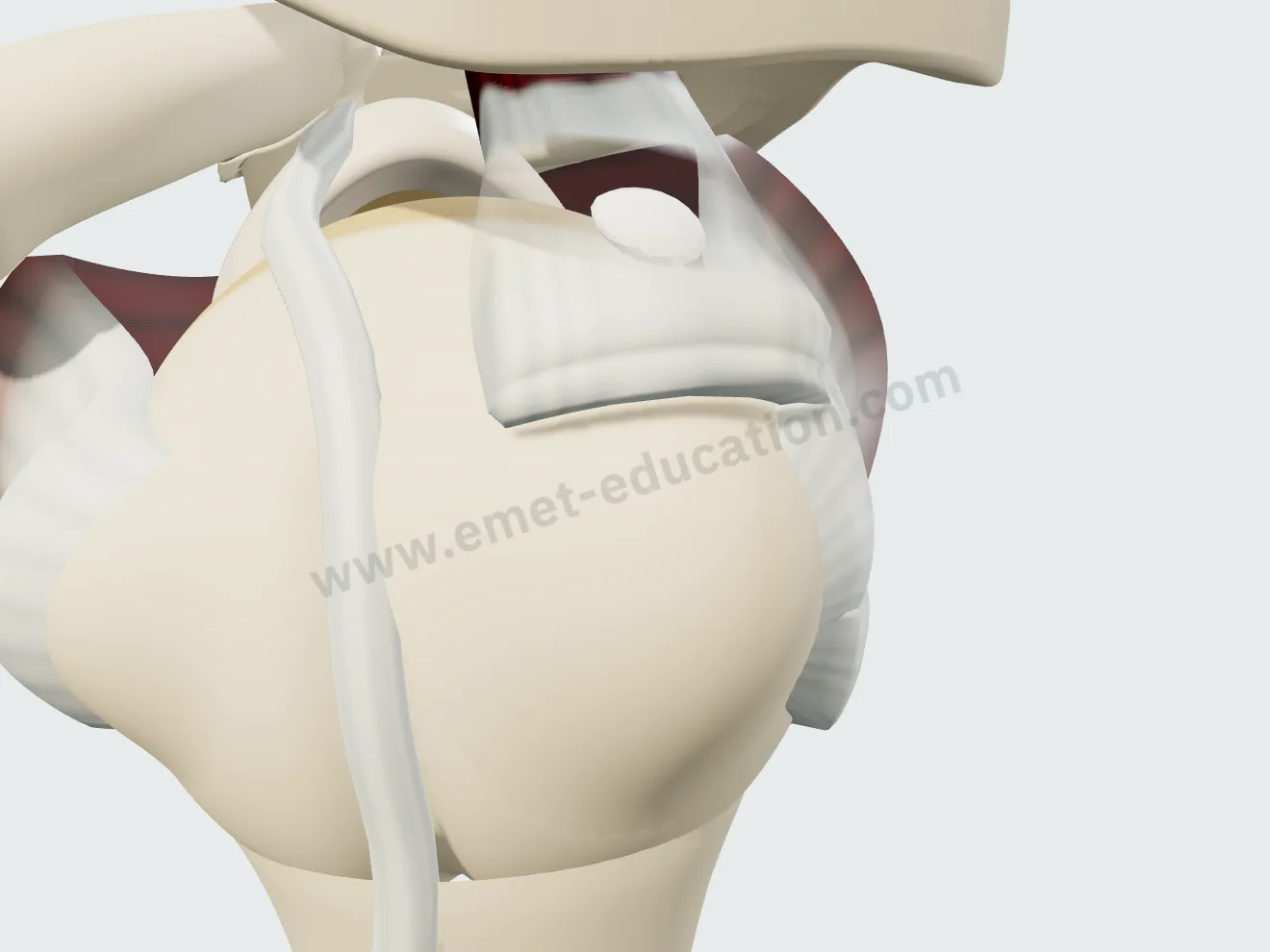 Calcification du supra-épineux de type A : dépôt unique, ovalaire, bien limité.