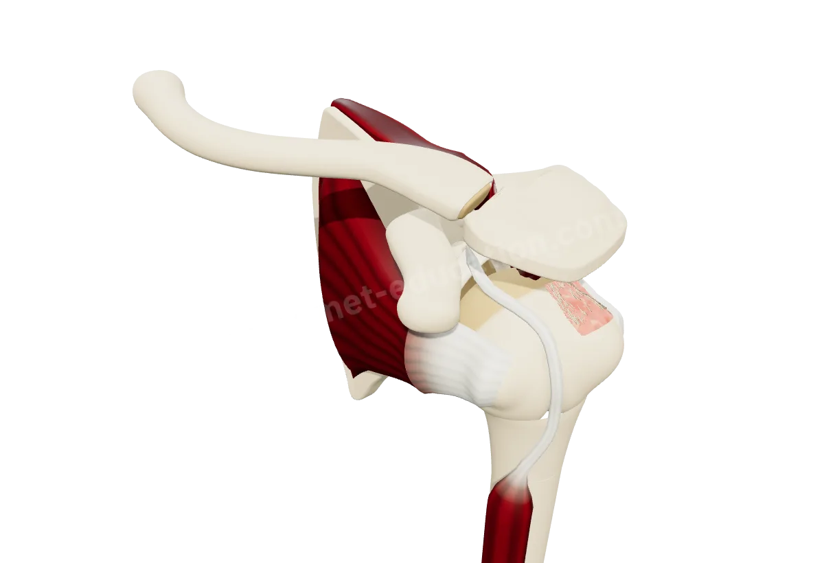 Modèle 3D de l'épaule : rupture du tendon supra-épineux, la zone d'attache sur l'os mise à nu