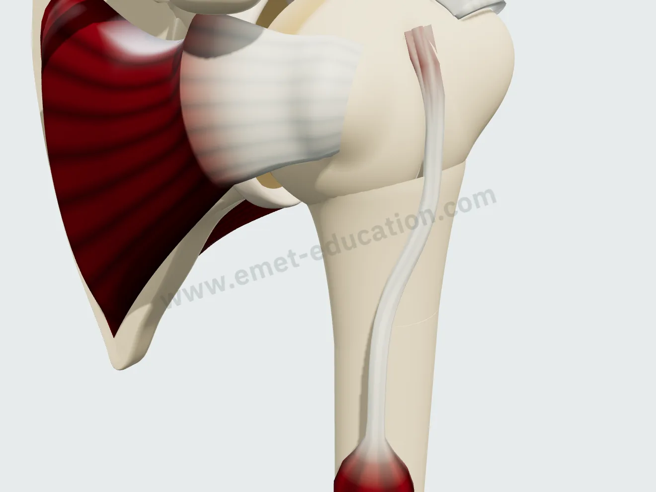 Rupture du long biceps : le tendon s'est rompu près de son attache, le muscle a glissé vers le bas.