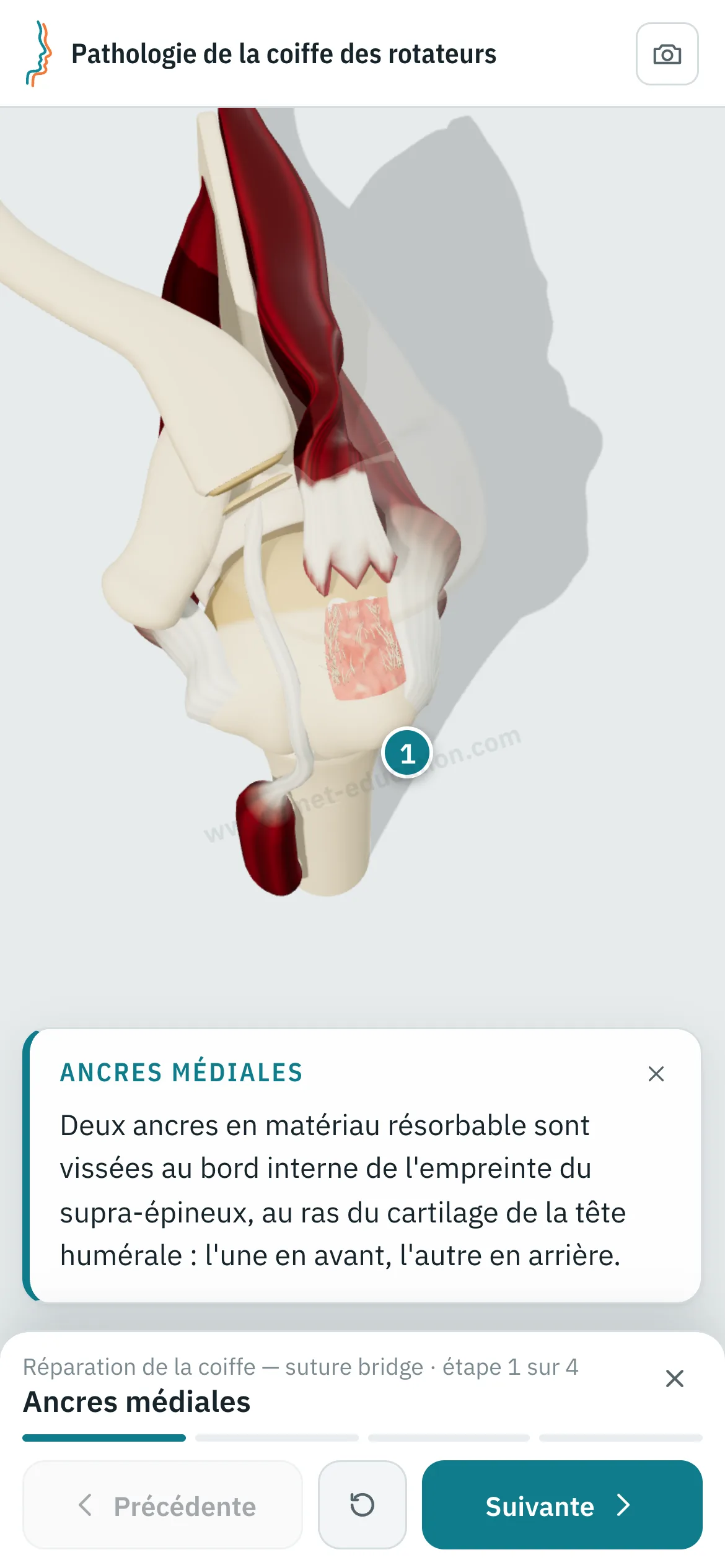 Vue patient sur un téléphone : la réparation en suture bridge rejouée étape par étape.