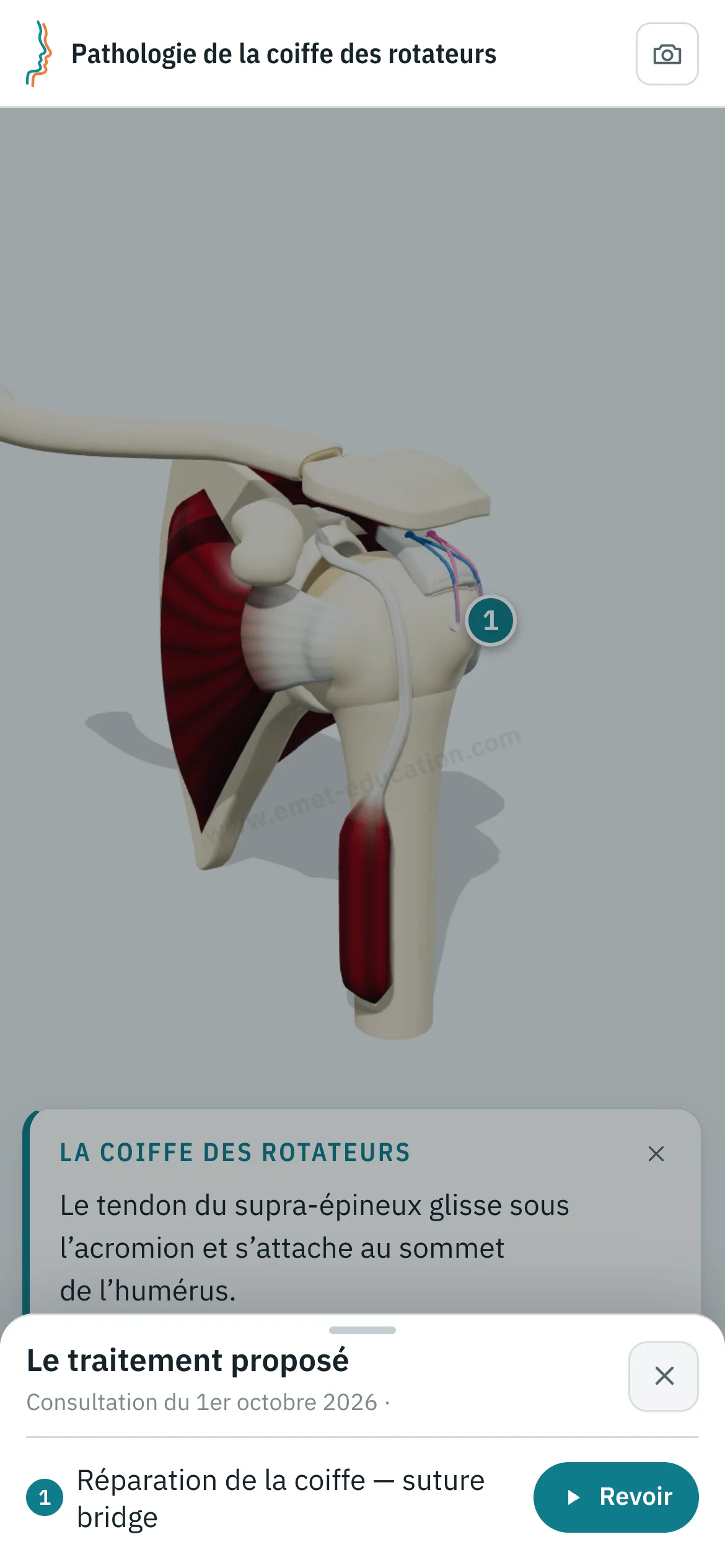 Vue patient sur un téléphone : l'épaule après réparation en suture bridge, et le volet « Le traitement proposé » ouvert : réparation de la coiffe en suture bridge, bouton « Revoir ».
