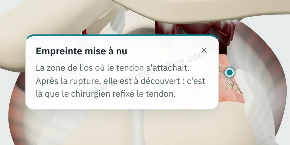 Bulle d'explication « Empreinte mise à nu » affichée après un toucher sur le tubercule majeur découvert par la rupture.