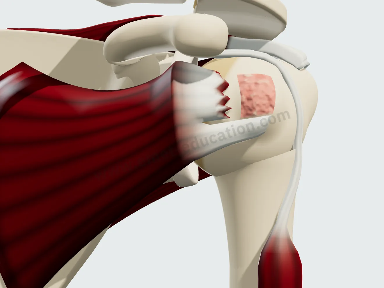 Vue antérieure : rupture des deux tiers supérieurs du sous-scapulaire (Lafosse III), le tubercule mineur découvert.