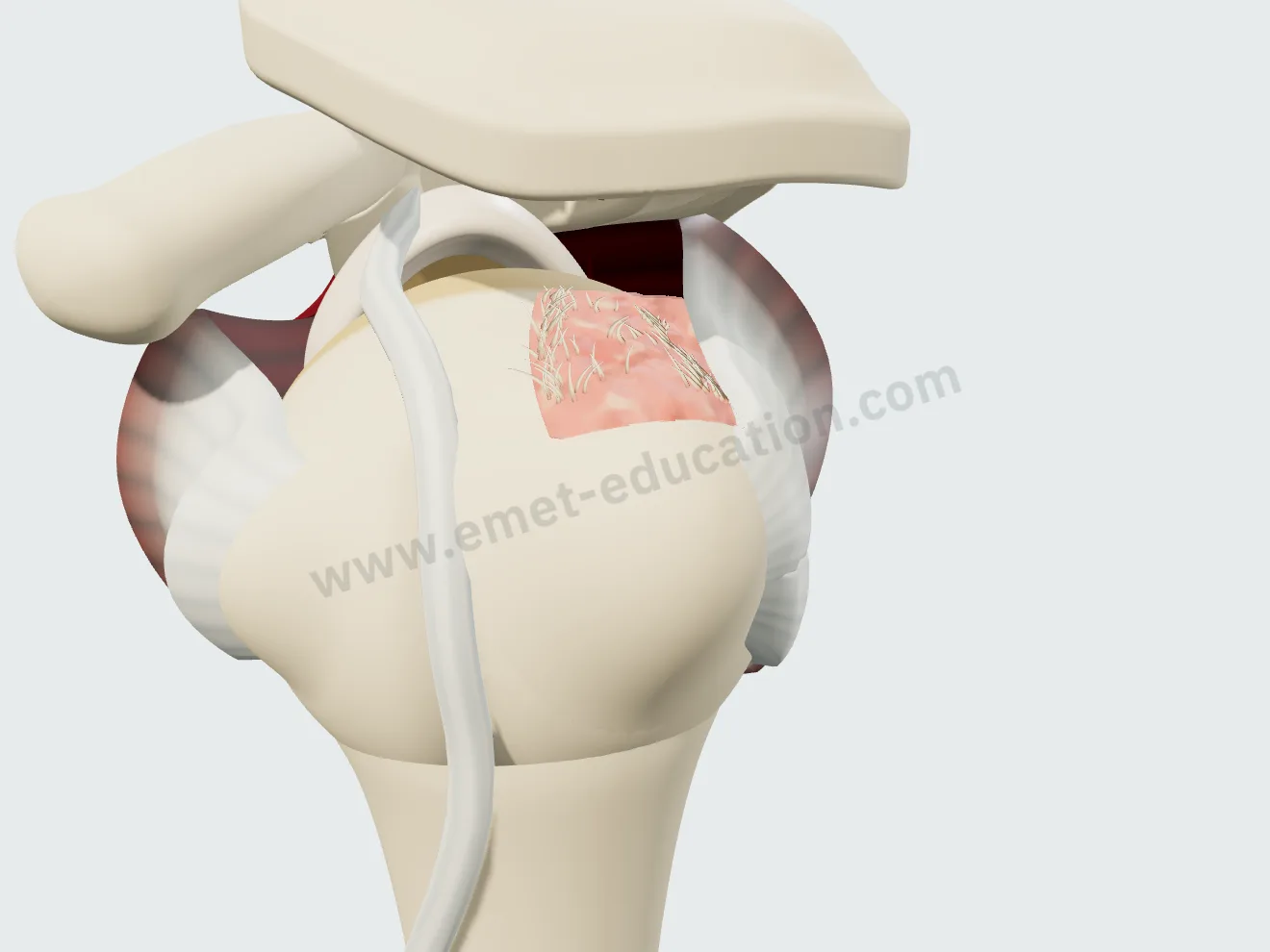 Rupture du supra-épineux très rétractée : le tendon a reculé jusqu'au niveau de l'articulation, sous l'acromion.