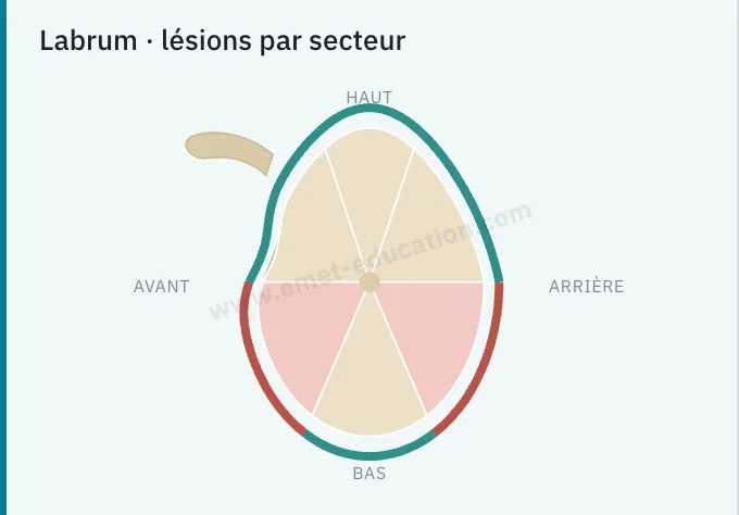 Panneau du modèle : la petite glène en six secteurs, secteurs antéro-inférieur et postéro-inférieur lésés.