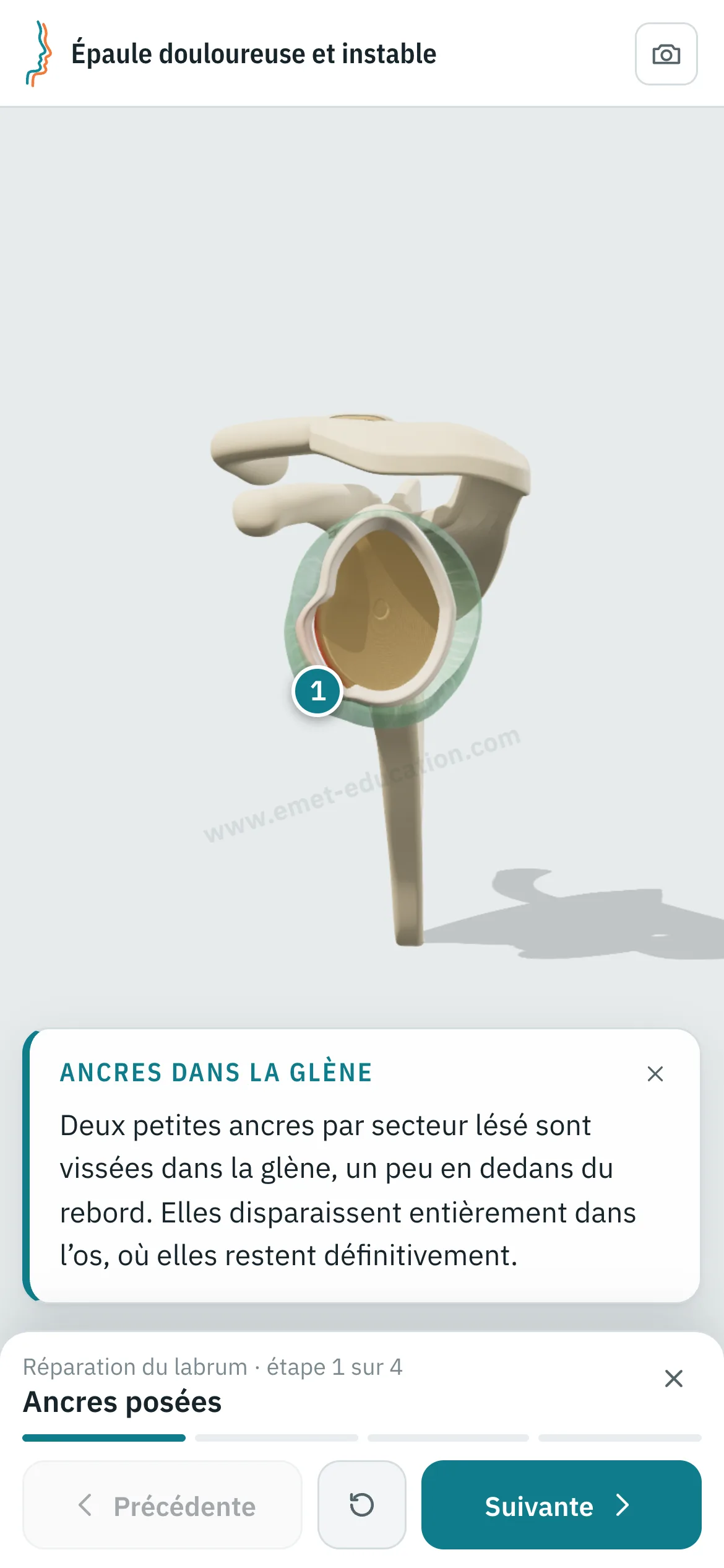 Vue patient sur un téléphone : la réparation du labrum rejouée étape par étape.