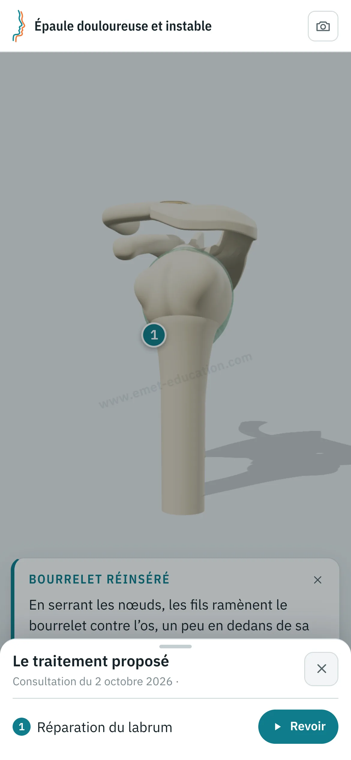Vue patient sur un téléphone : le labrum réparé, et le volet « Le traitement proposé » ouvert, avec le bouton « Revoir ».