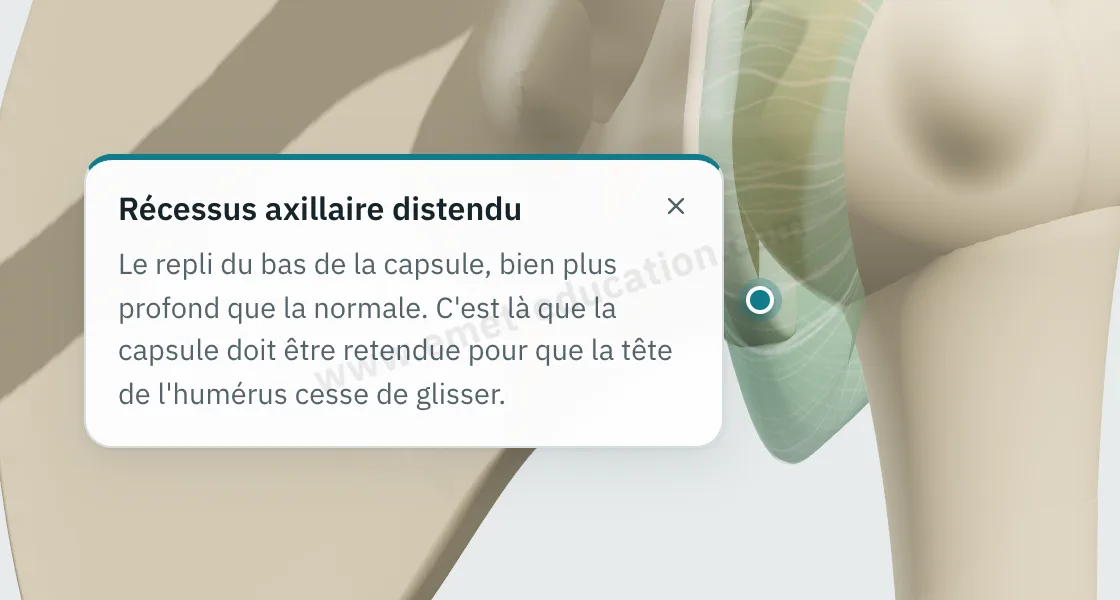 Bulle d'explication « Récessus axillaire distendu » affichée après un toucher sur la capsule, sous la tête humérale.