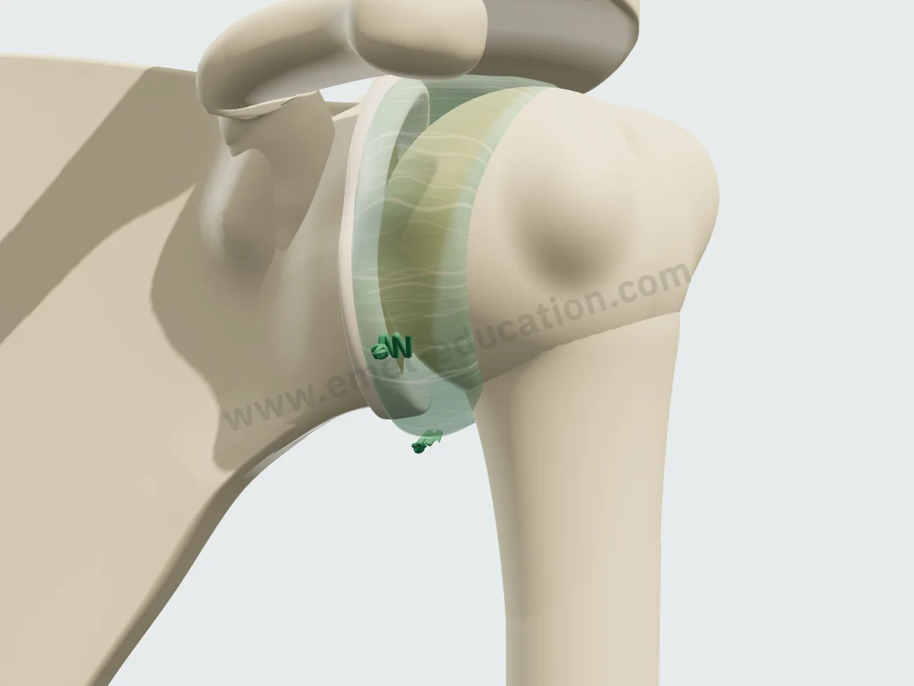 Retension capsulaire, étape 2 : nœuds serrés, la capsule retendue et le récessus refermé.