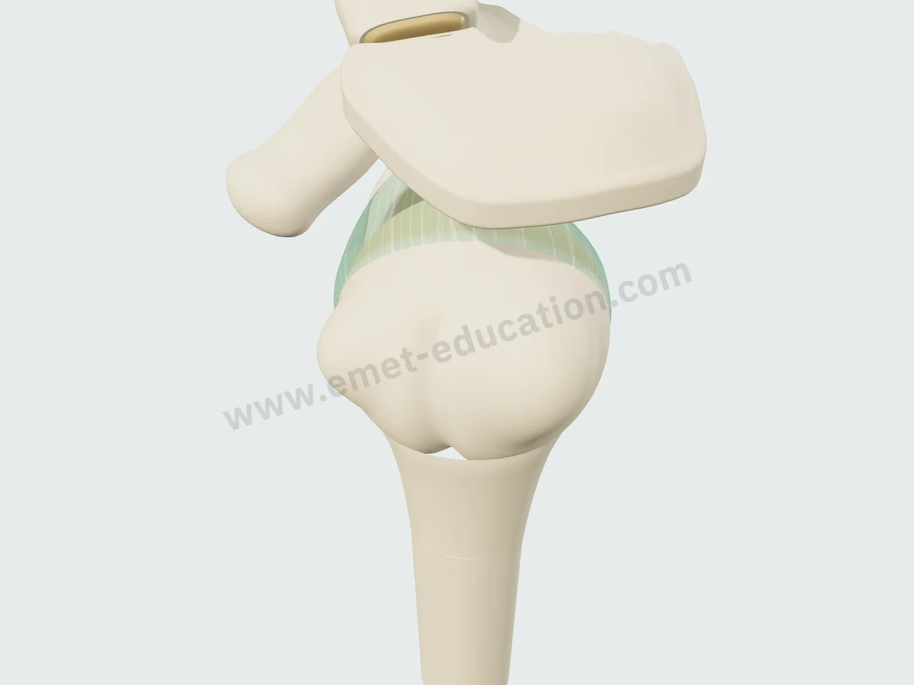 Réparation du labrum, étape 4 : la tête poussée en avant ne glisse plus que de 10 à 20 %.
