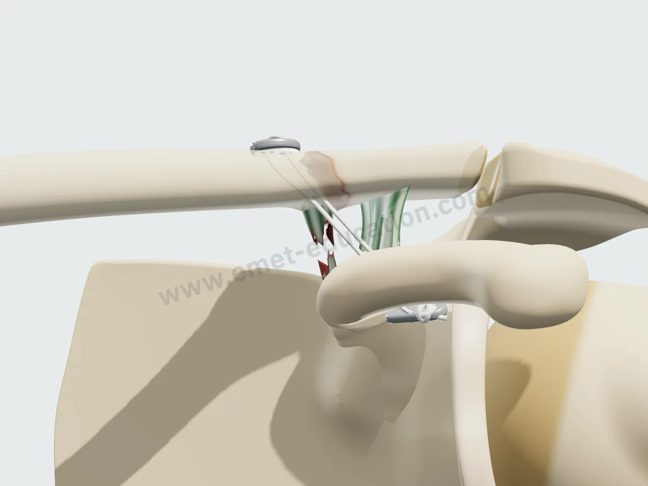 Endobouton coraco-claviculaire : des fils tendus entre deux boutons relient la clavicule à la coracoïde.